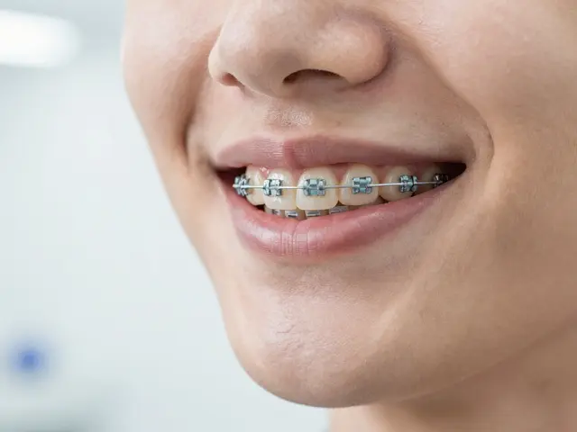 Keramická rovnátka: Kolik stojí a jak na zaplacení?